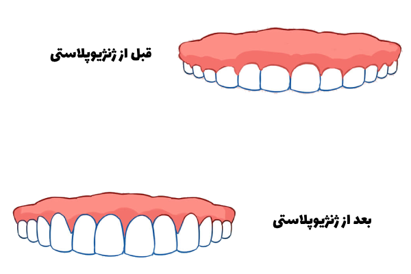 جراحی لثه زیبایی