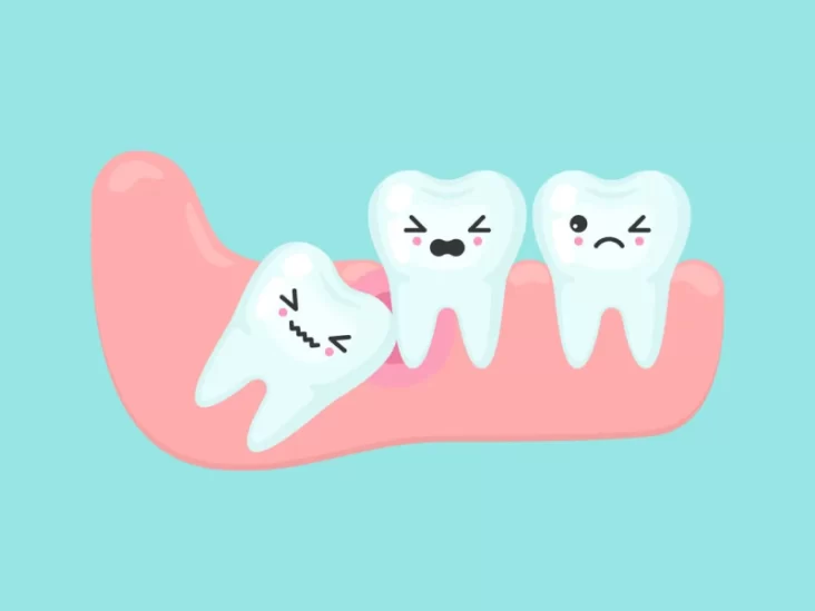 Wisdom tooth surgery with MIVADENT