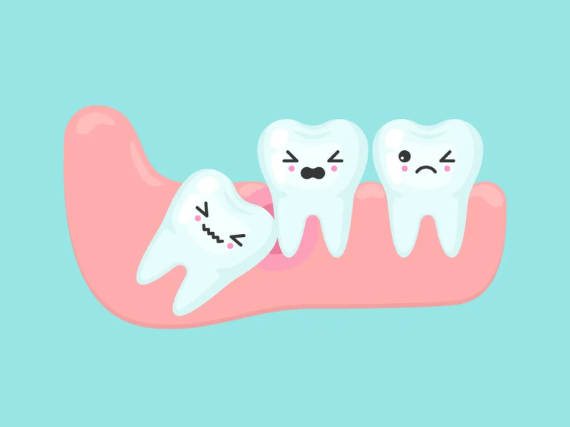 جراحی دندان عقل با میوادنت