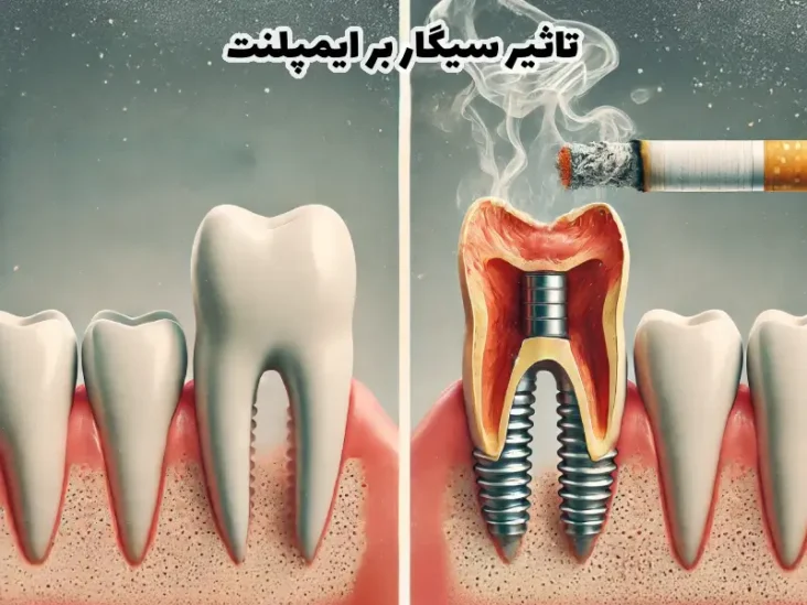 تاثیر سیگار بر ایمپلنت